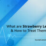 What Are Strawberry Legs & How To Treat Them